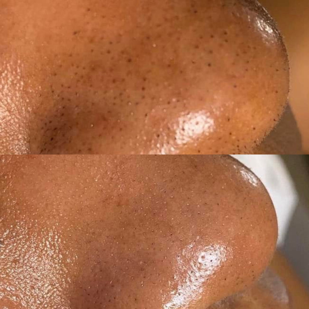Breakout Classic Nose (Before & After) 1 - Skin Choice