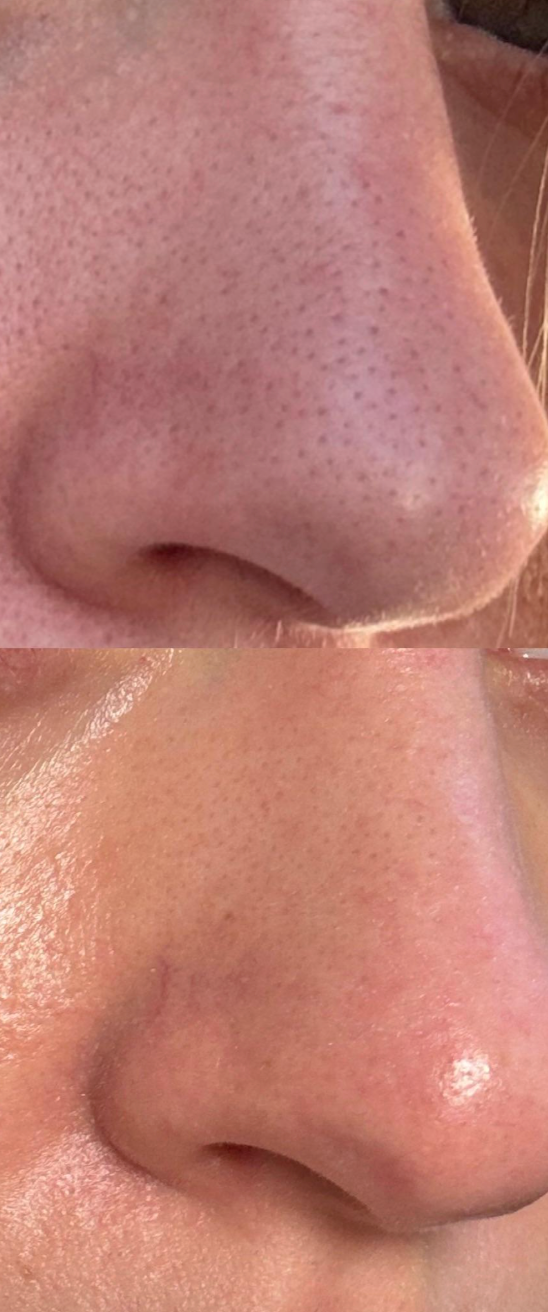 Breakout Classic Nose (Before & After) 3 - Skin Choice