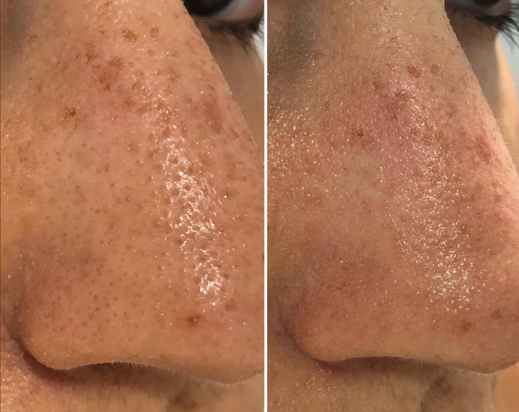 Breakout Classic Nose (Before & After) 4 - Skin Choice