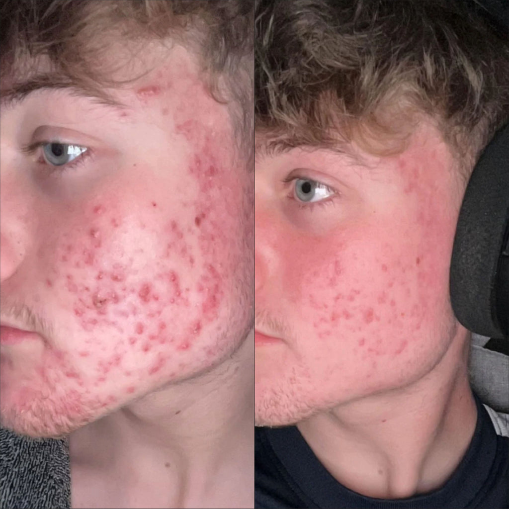 Breakout Classic XL 3 (Before & After) 3 - Skin Choice