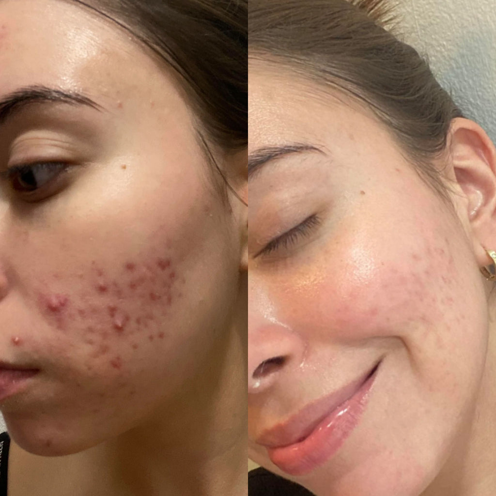Breakout Classic Xtra (Before & After) 1 - Skin Choice