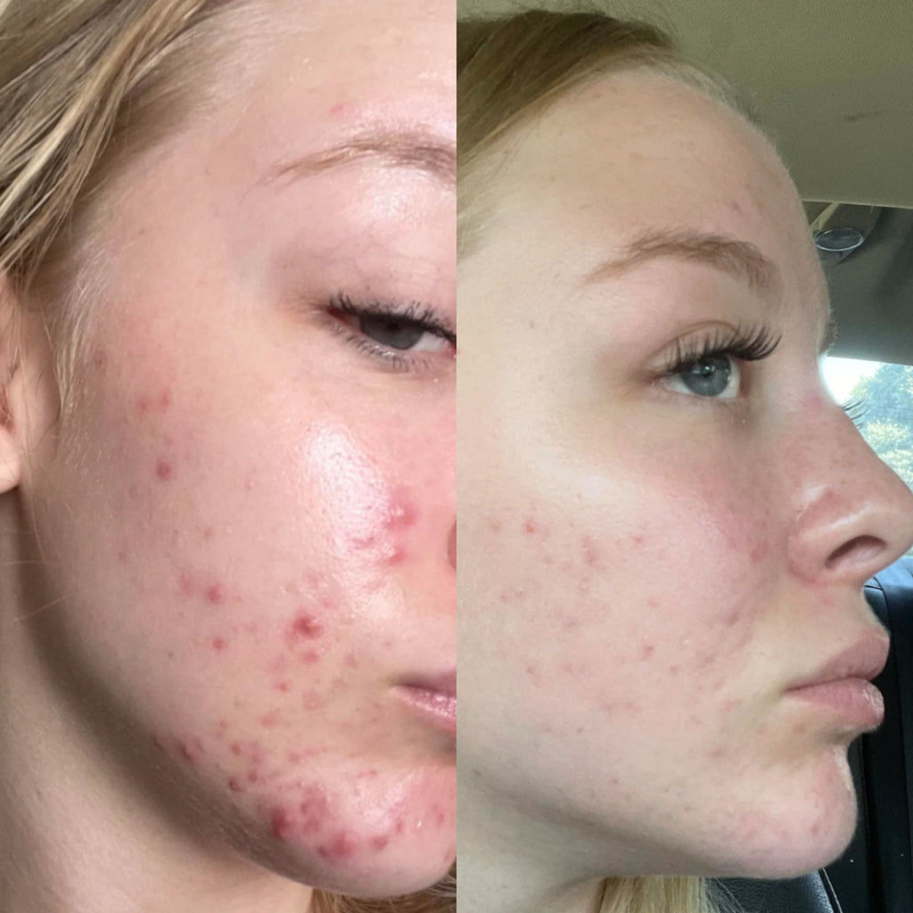 Breakout Classic Xtra (Before & After) 2 - Skin Choice
