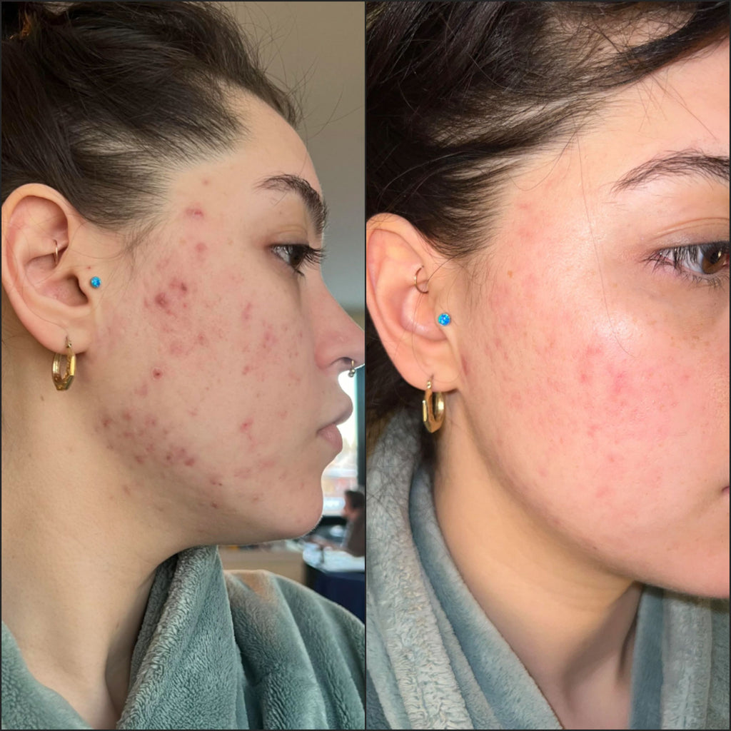 Breakout Classic Xtra (Before & After) 4 - Skin Choice