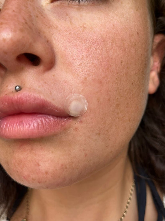 How Long Should You Leave Hydrocolloid Patch On? - Skin Choice