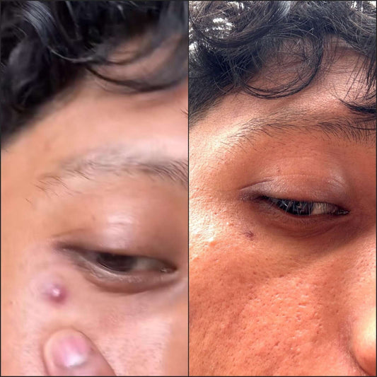 Ouch! Taming Painful Pimples with Relief Strategies That Work - Skin Choice