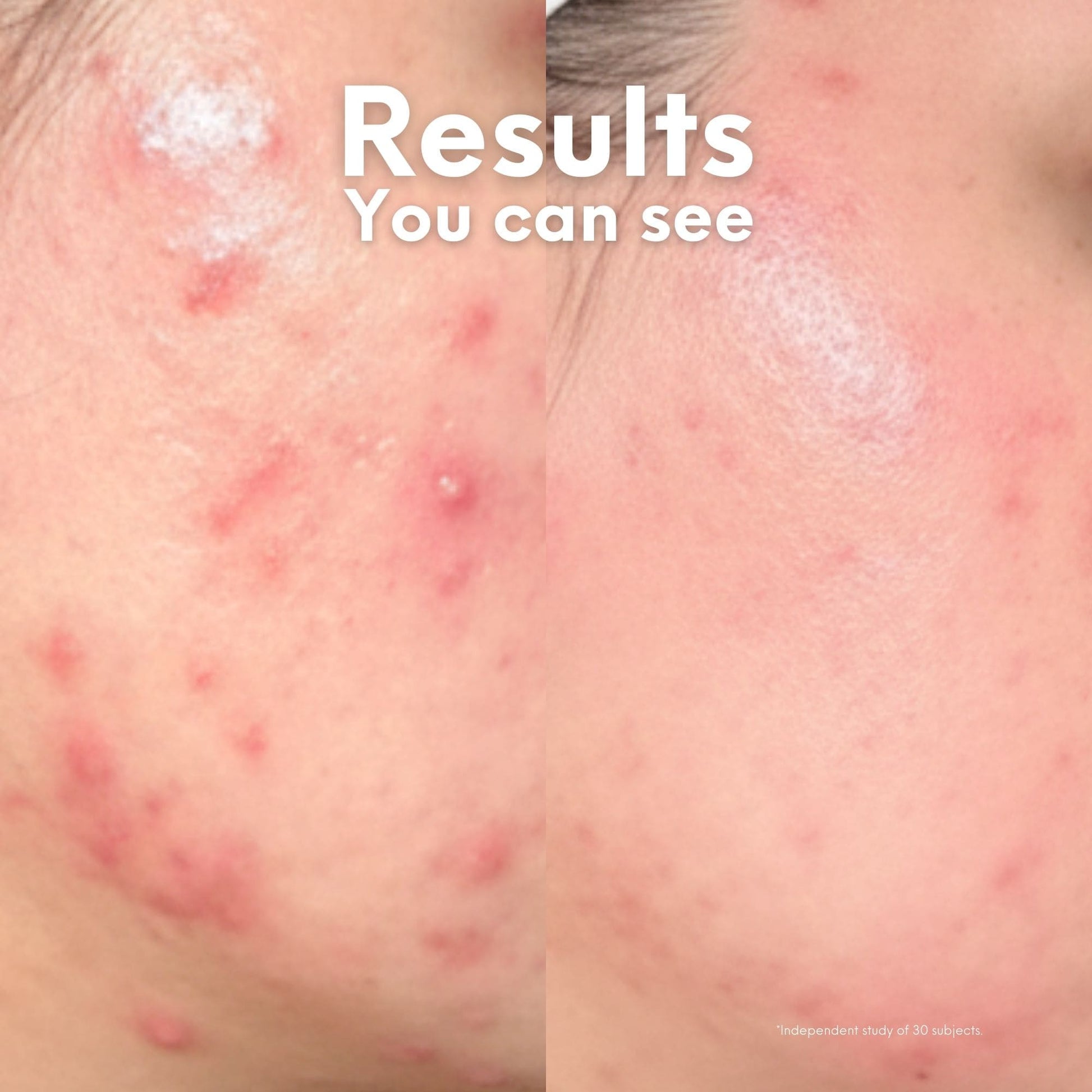 Breakout Patch Classic XL - Skin Choice