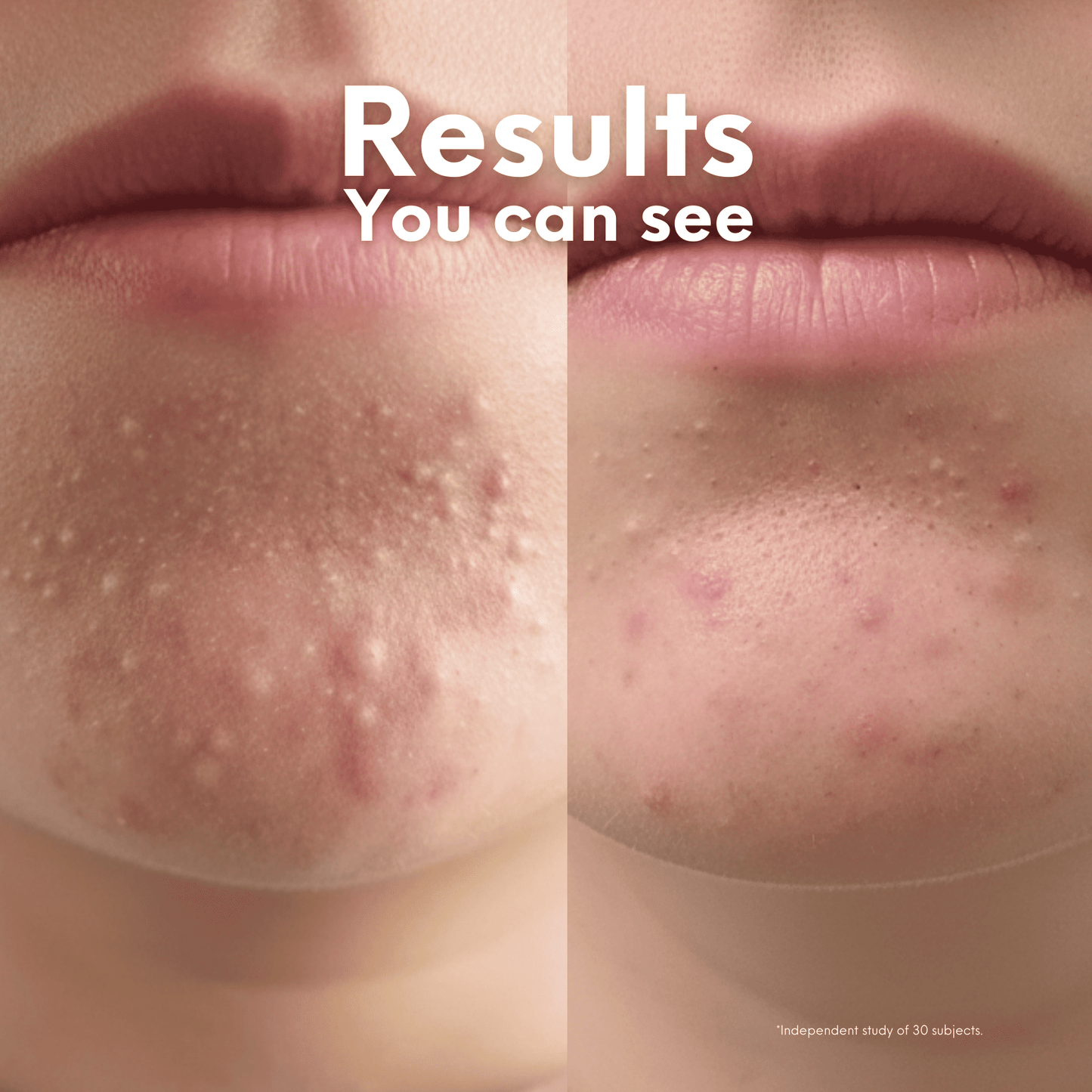 Breakout Patch Classic Xtra - Skin Choice