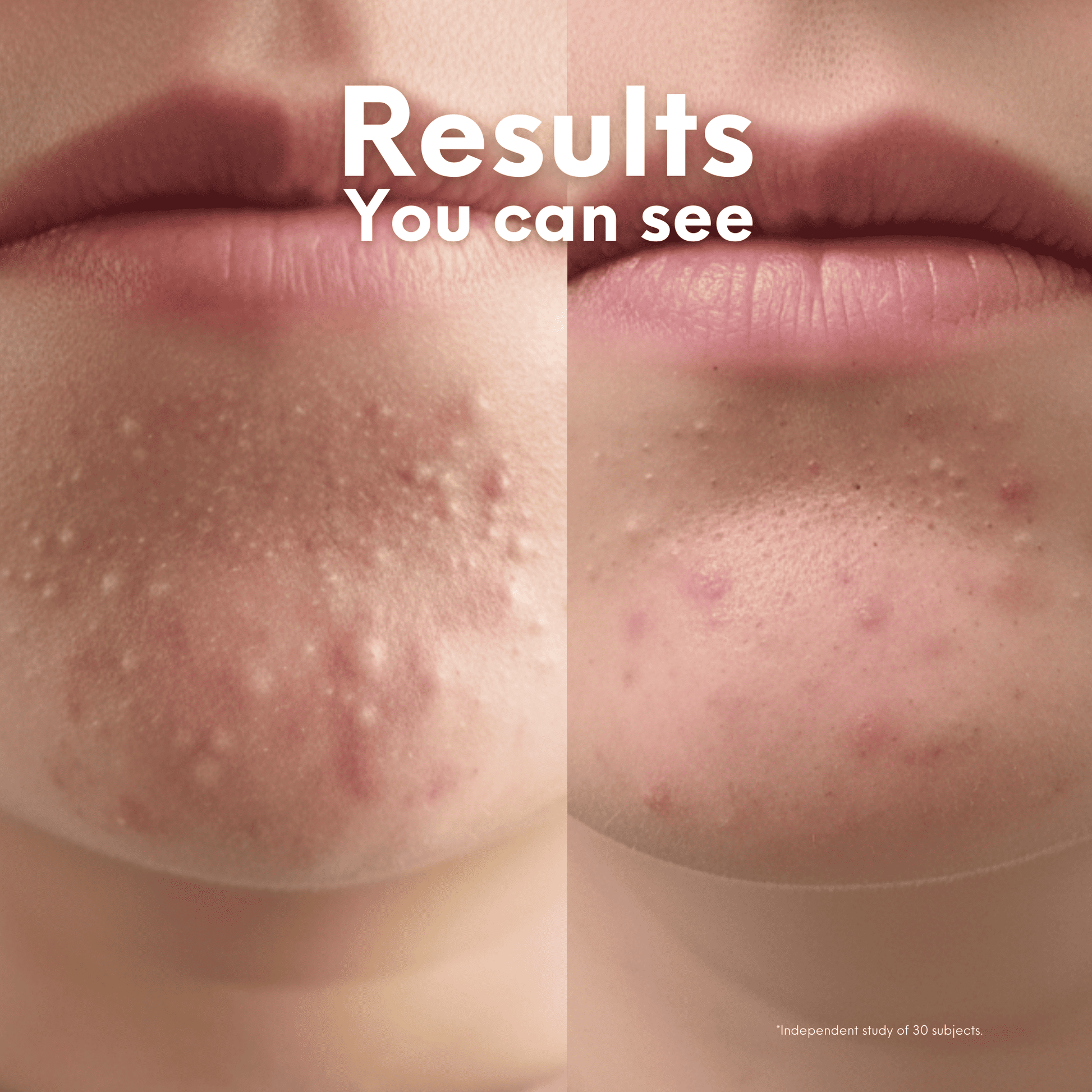 Breakout Patch Classic Xtra - Skin Choice