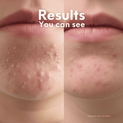 Breakout Patch Classic Xtra - Skin Choice