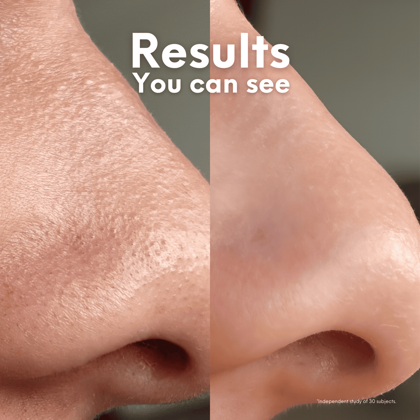 Nose Patches (with Reusable Cotton Rounds) - Skin Choice