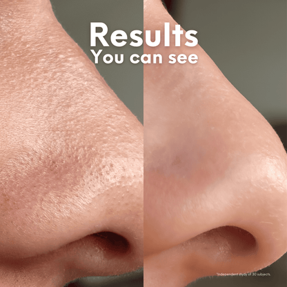 Nose Patches (with Reusable Cotton Rounds) - Skin Choice